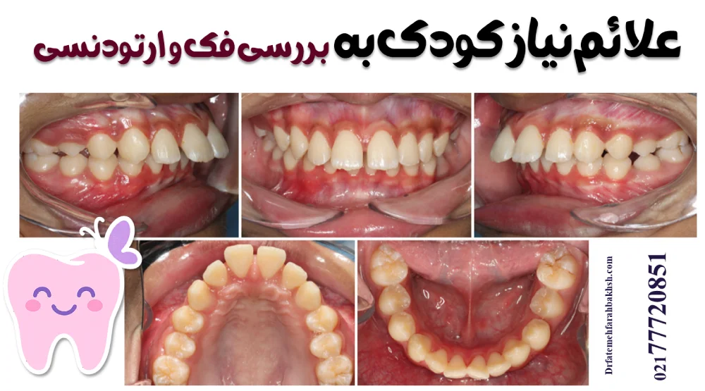 علائم نیاز کودک به بررسی فک و ارتودنسی