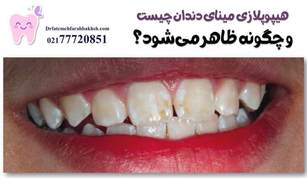 اهمیت استفاده از فضانگهدار پس از کشیدن دندان شیری