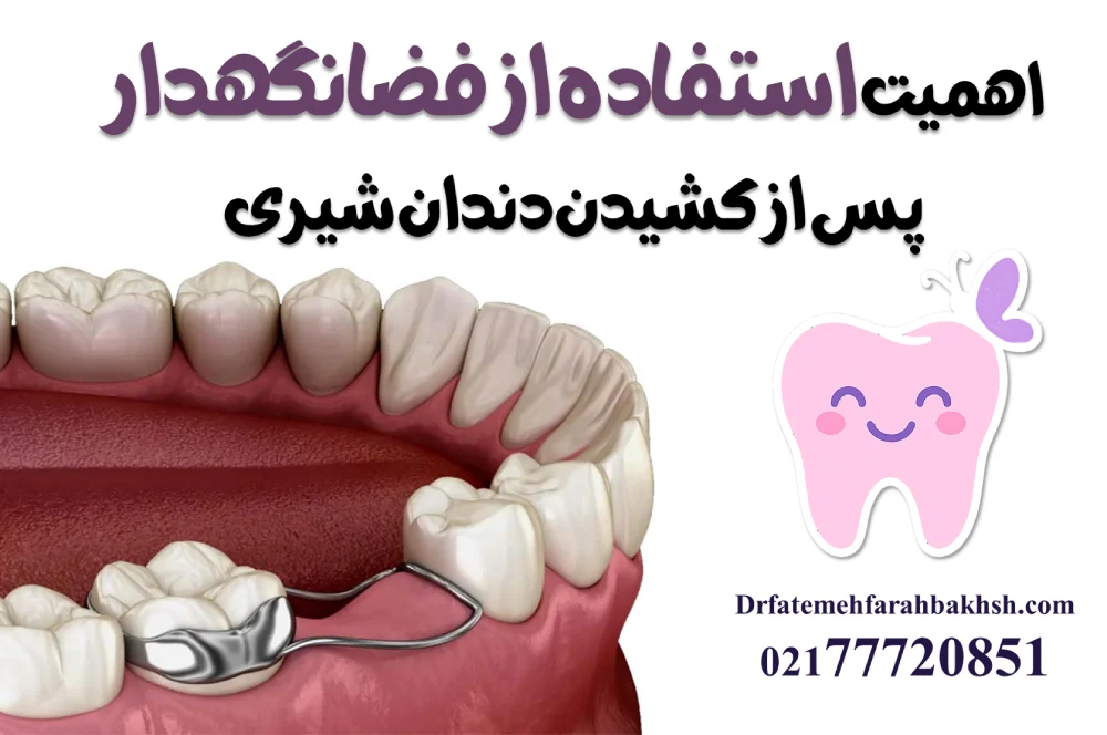 اهمیت استفاده از فضانگهدار پس از کشیدن دندان شیری