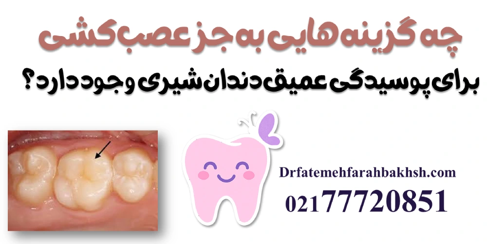 درمان پوسیدگی عمیق دندان شیری؛ آیا همیشه نیاز به عصب‌کشی است؟