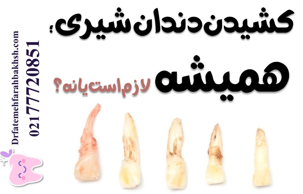دندان دائمی پشت دندان شیری (دندان کوسه‌ای)