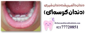 دندان دائمی پشت دندان شیری (دندان کوسه‌ای)