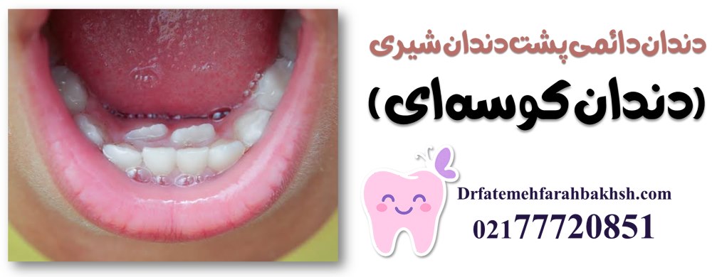دندان دائمی پشت دندان شیری (دندان کوسه‌ای)