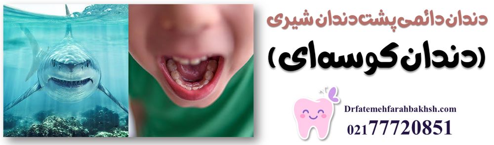 دندان دائمی پشت دندان شیری (دندان کوسه‌ای)