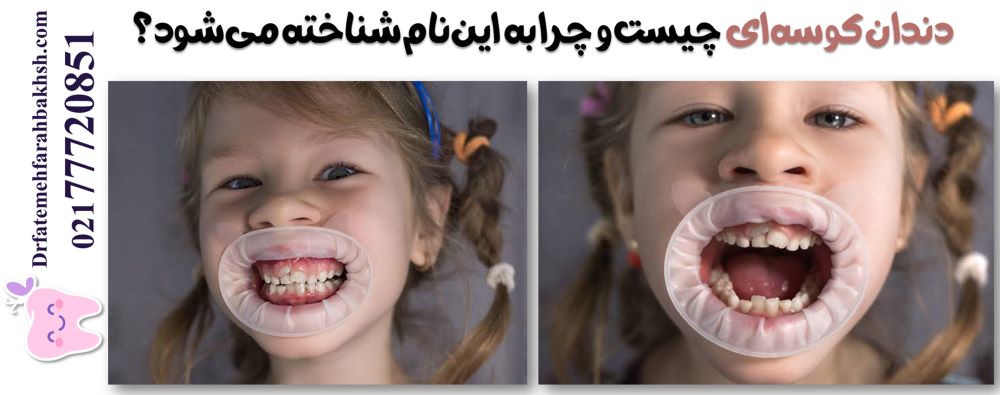 دندان کوسه‌ای چیست و چرا به این نام شناخته می‌شود؟