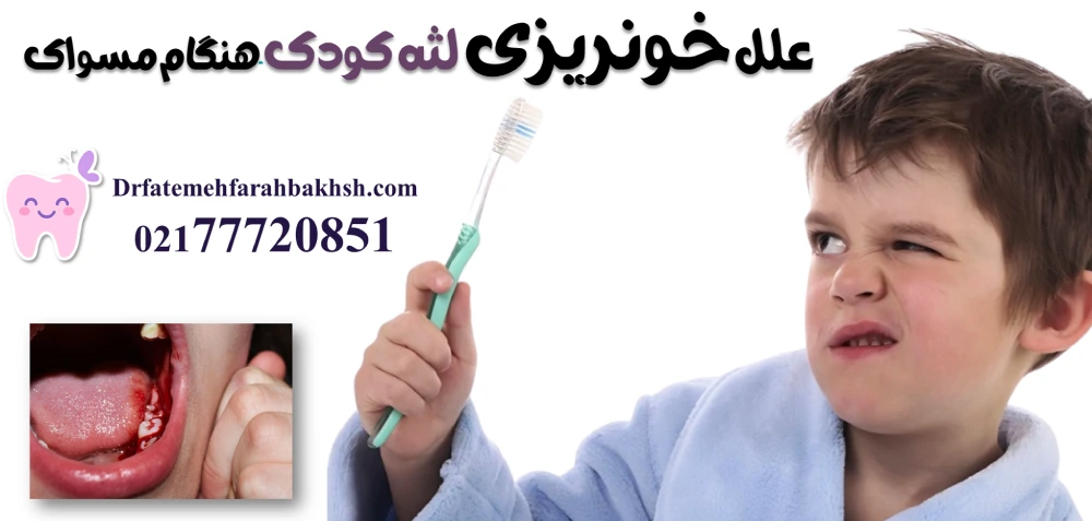 علل خونریزی لثه کودک هنگام مسواک