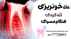 علل خونریزی لثه کودک هنگام مسواک