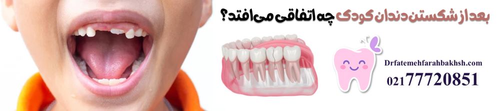 درمان دندان شکسته کودک بعد از زمین خوردن
