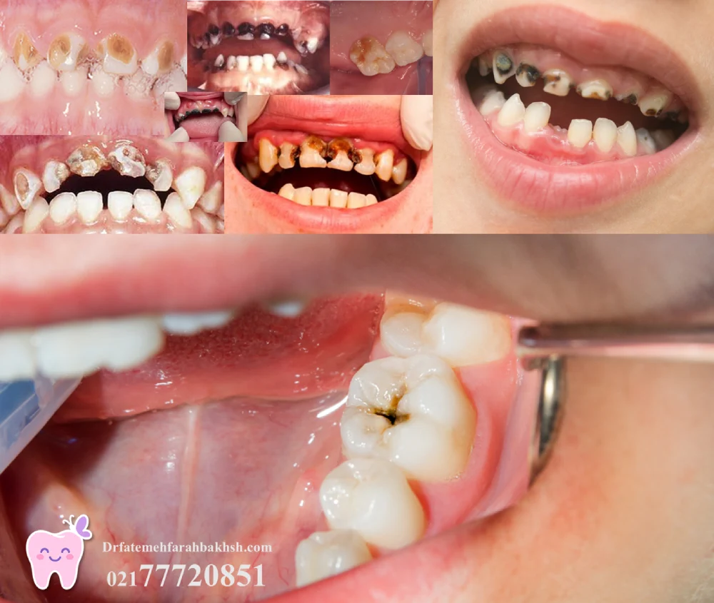 پوسیدگی دندان شیری؛ چرا نباید نادیده گرفته شود؟