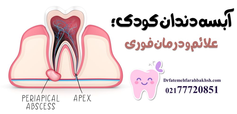 آبسه دندان کودک؛ علائم و درمان فوری