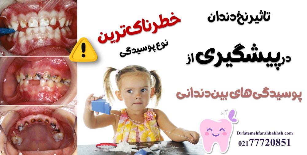 چرا نخ دندان کشیدن برای کودک از نظر دکتر فرح بخش حیاتی است؟