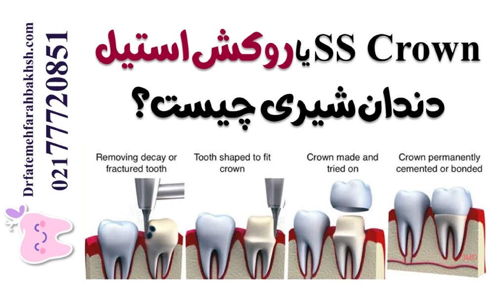 روکش دندان شیری کودکان (SS Crown) چیست و چه زمانی لازم است؟