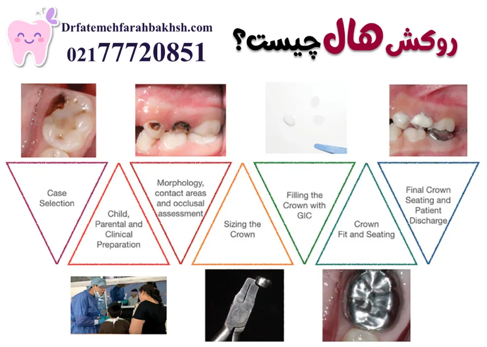 روکش دندان شیری کودکان (SS Crown) چیست و چه زمانی لازم است؟