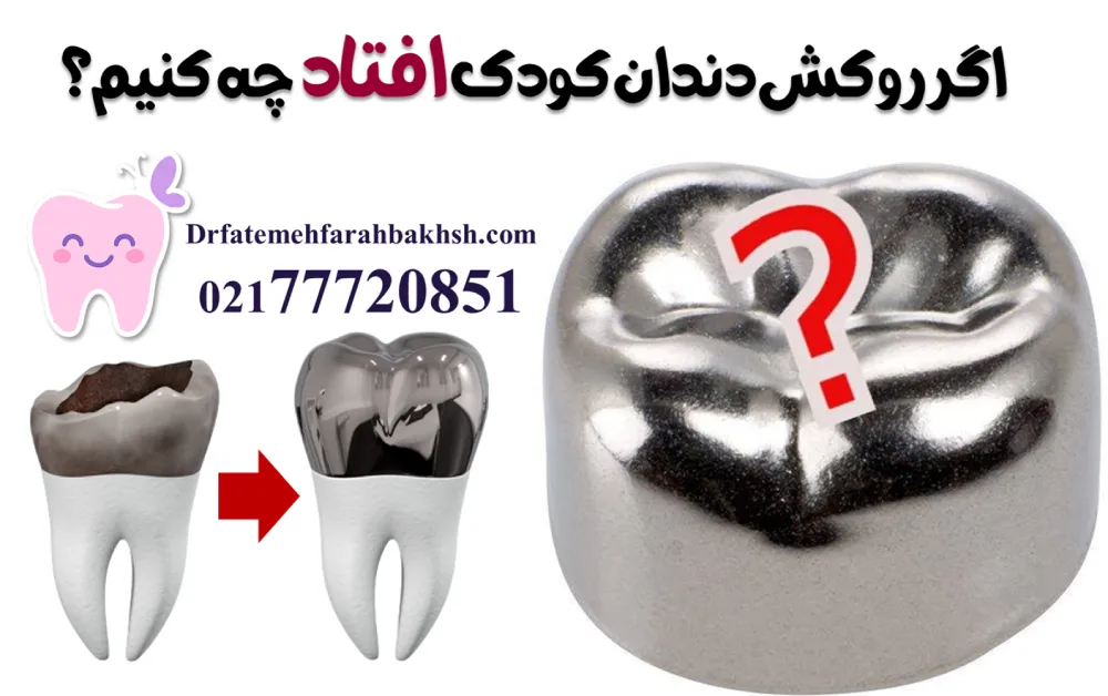 روکش دندان شیری کودکان (SS Crown) چیست و چه زمانی لازم است؟