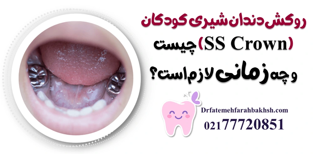 روکش دندان شیری کودکان (SS Crown) چیست و چه زمانی لازم است؟